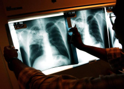 В Астраханской области улучшают систему диагностики туберкулеза